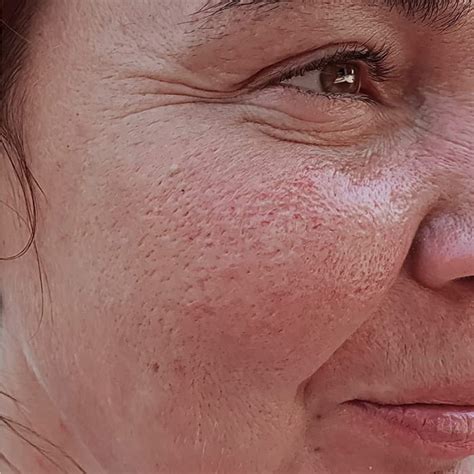 SKIN .
